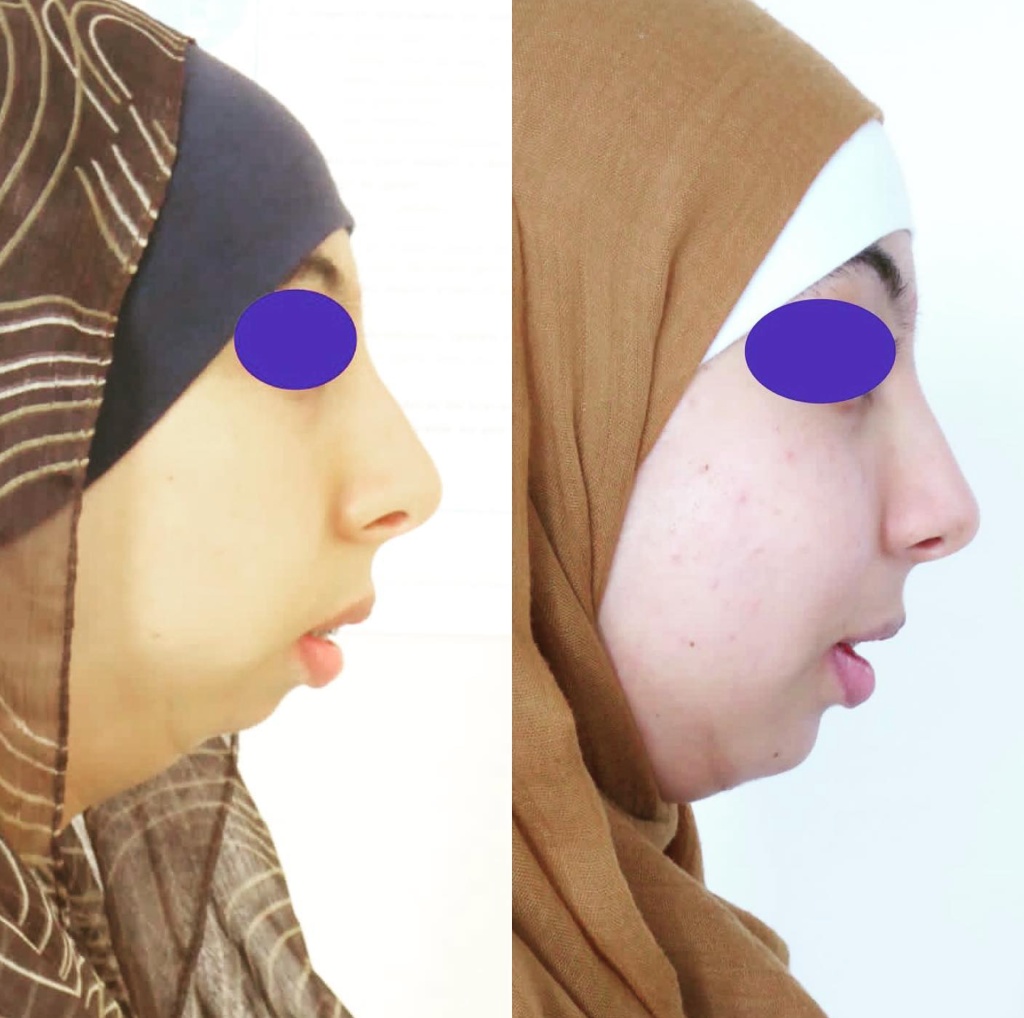 Résultat chirurgie orthognatique — avant / après, profil