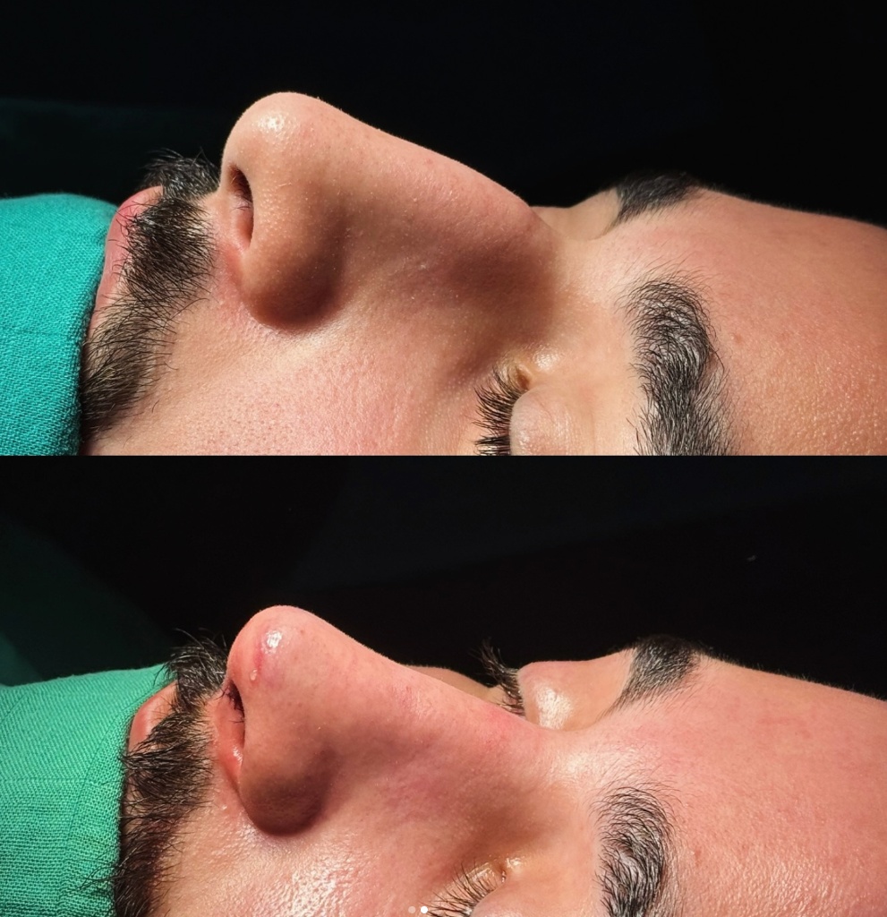 Résultat rhinoplastie — avant / après, vue sous le nez